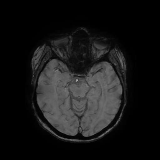 Cerebral metastases - melanoma (Radiopaedia 80972-94522 Axial SWI 40).jpg
