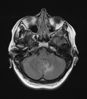 File:Cerebral metastases mimicking abscesses (Radiopaedia 45841-50131 Axial FLAIR 7).png