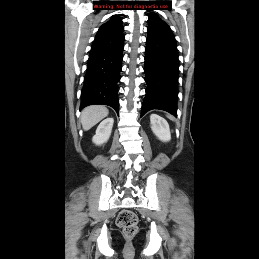 Cerebral metastasis - colorectal carcinoma (Radiopaedia 8581-83548 A 64).jpg