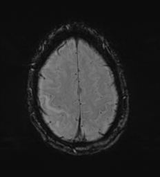 Cerebral metastasis - melanoma (Radiopaedia 54718-60954 Axial SWI 48).png