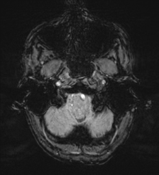 Cerebral metastasis - melanoma (Radiopaedia 54718-60954 Axial SWI 6).png
