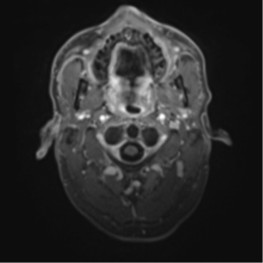 Cerebral metastasis - melanoma (Radiopaedia 54718-60954 Axial T1 C+ fat sat 1).png