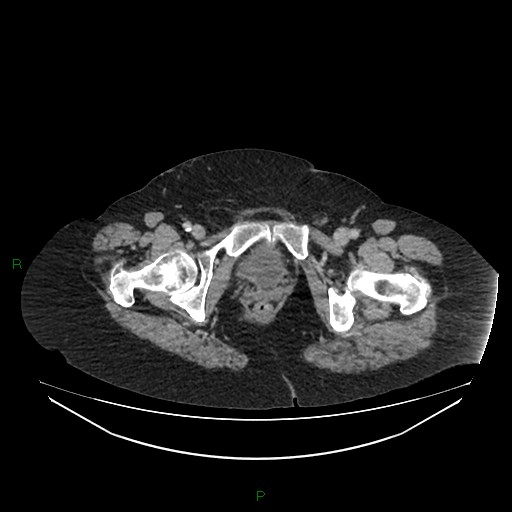 Cerebral metastasis from renal cell carcinoma (Radiopaedia 82306-96378 A 191).jpg