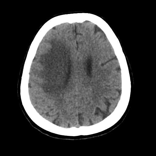 File:Cerebral metastasis to basal ganglia (Radiopaedia 81568-95412 Axial non-contrast 44).png