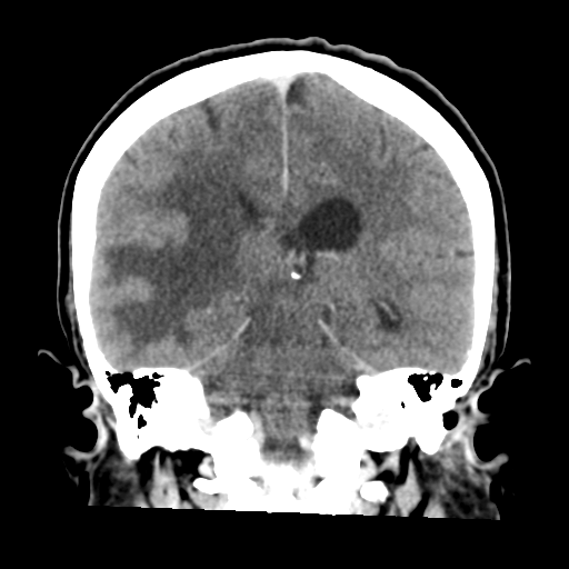 Cerebral metastasis to basal ganglia (Radiopaedia 81568-95412 Coronal C+ delayed 38).png