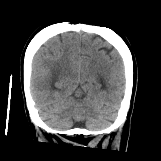 Cerebral metastasis to basal ganglia (Radiopaedia 81568-95412 Coronal non-contrast 51).png