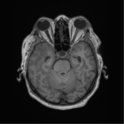 Cerebral metastasis to basal ganglia (Radiopaedia 81568-95413 Axial T1 22).png