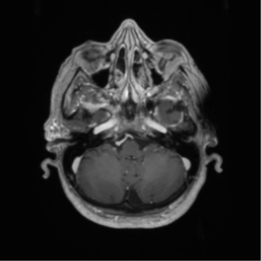 Cerebral metastasis to basal ganglia (Radiopaedia 81568-95413 Axial T1 C+ 14).png