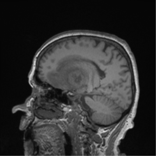 Cerebral metastasis to basal ganglia (Radiopaedia 81568-95413 Sagittal T1 45).png
