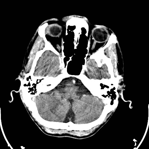 File:Cerebral toxoplasmosis (Radiopaedia 43956-47460 Axial C+ delayed 4).jpg