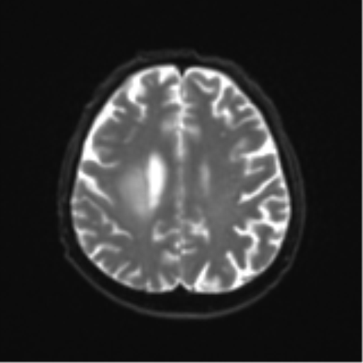 File:Cerebral toxoplasmosis (Radiopaedia 54575-60804 Axial DWI 23).png