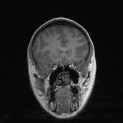 Cerebral tuberculosis with dural sinus invasion (Radiopaedia 60353-68090 Coronal T1 64).jpg