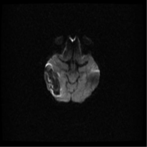 Cerebral venous hemorrhagic infarction (Radiopaedia 38461-40552 Axial DWI 17).png