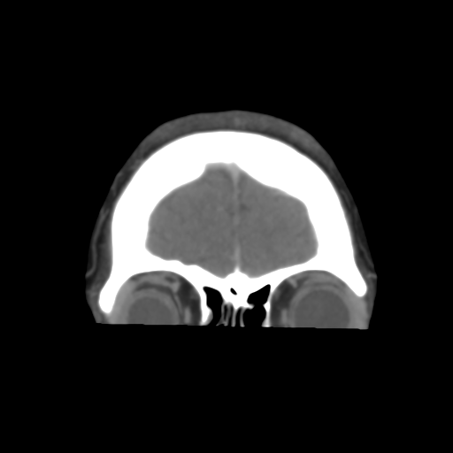 File:Cerebral venous infarction due to transverse sinus thrombosis (Radiopaedia 34688-36120 Coronal 12).png