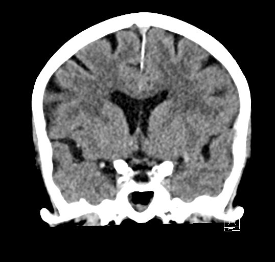 Cerebral venous infarction with hemorrhage (Radiopaedia 65343-74381 Coronal non-contrast 20).jpg