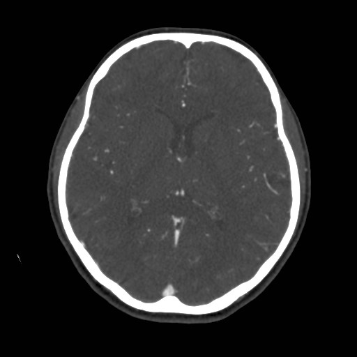 Cerebral venous sinus thrombosis (Radiopaedia 40619-43227 A 123).jpg