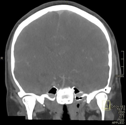 File:Cerebral venous sinus thrombosis (Radiopaedia 91329-108965 Coronal venogram 45).jpg
