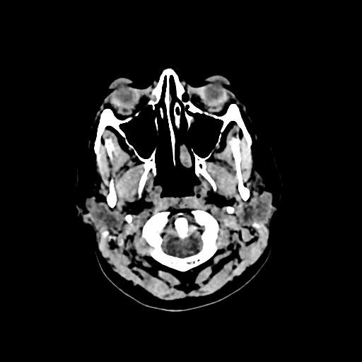 Cerebral venous throbmosis - hemorrhagic venous infarction (Radiopaedia 87318-103613 Axial non-contrast 2).jpg