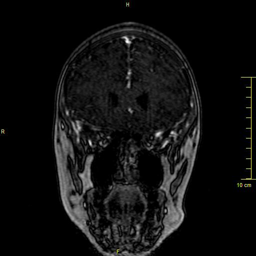 Cerebral venous thrombosis (Radiopaedia 23288-23351 MRV 25).JPG