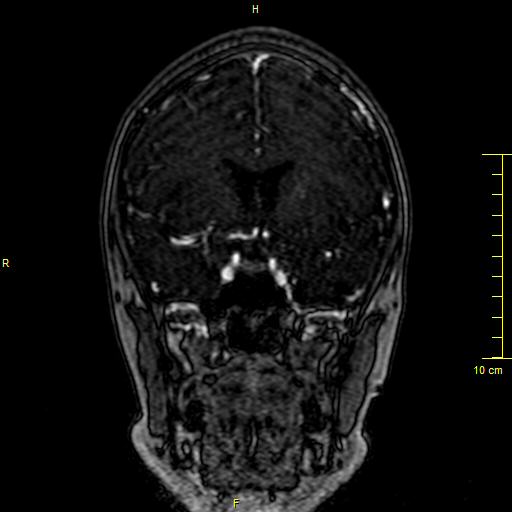 File:Cerebral venous thrombosis (Radiopaedia 23288-23351 MRV 47).JPG