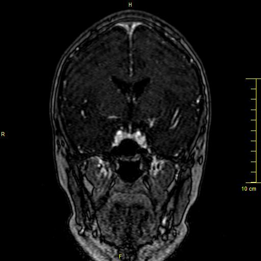 File:Cerebral venous thrombosis (Radiopaedia 23288-23351 MRV 57).JPG