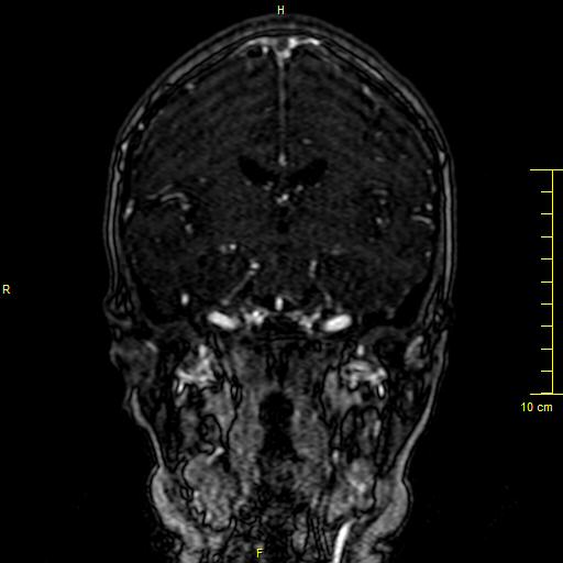 Cerebral venous thrombosis (Radiopaedia 23288-23351 MRV 76).JPG