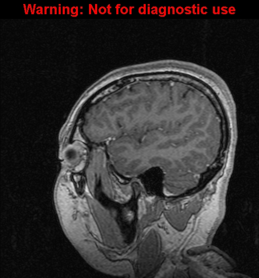 File:Cerebral venous thrombosis (Radiopaedia 37224-39208 Sagittal T1 C+ 32).jpg