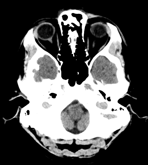 File:Cerebral venous thrombosis (Radiopaedia 38392-40467 Axial non-contrast 5).png