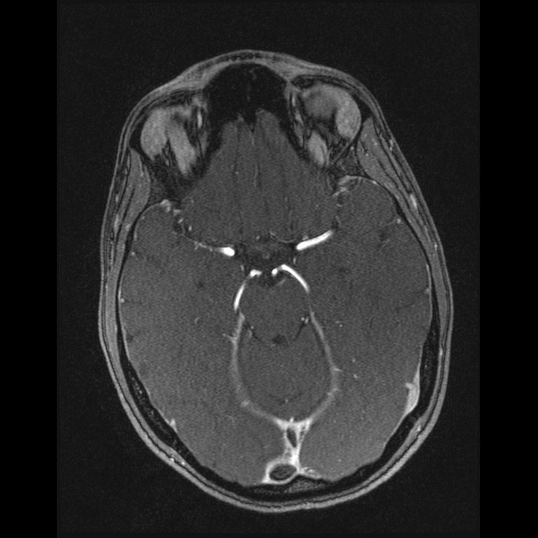 Cerebral venous thrombosis (Radiopaedia 45678-49854 Axial MRV 26).jpg