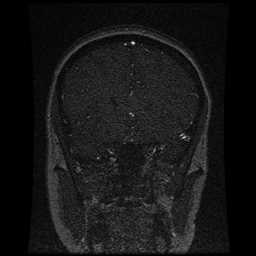 Cerebral venous thrombosis - ulcerative colitis (Radiopaedia 66049-75219 Coronal MRV 81).jpg