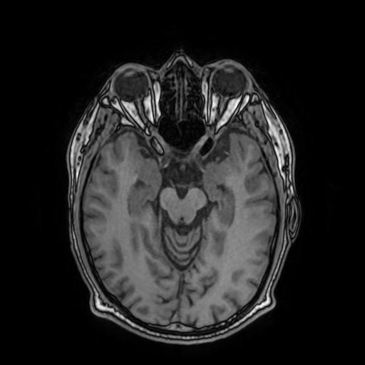 File:Cerebral venous thrombosis with secondary intracranial hypertension (Radiopaedia 89842-106957 Axial T1 79).jpg