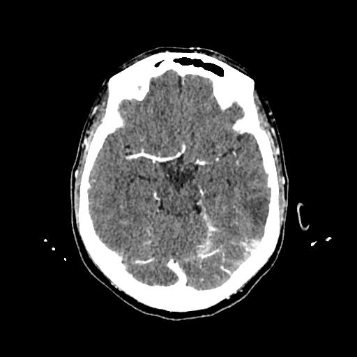 Cerebral venous thrombosis with venous hemorrhagic infarct (Radiopaedia 90354-107660 Axial with contrast 65).jpg