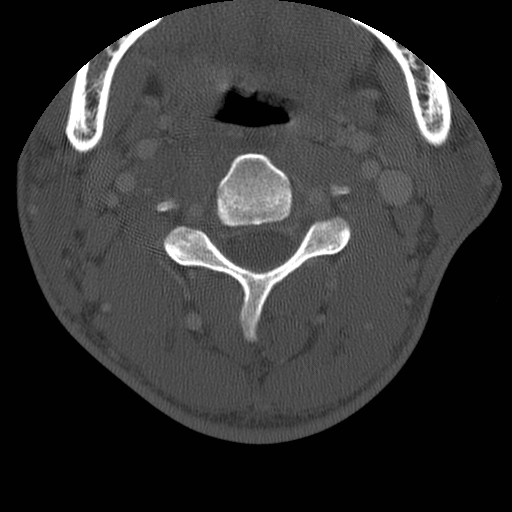 Cervical Pott disease (Radiopaedia 20374-20286 Axial bone window 58).jpg