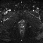 Cervical adenocarcinoma (Radiopaedia 65011-73985 Axial DWI 13).jpg