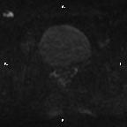 Cervical adenocarcinoma (Radiopaedia 65011-73985 Axial DWI 33).jpg