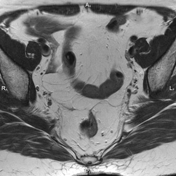 File:Cervical adenocarcinoma (Radiopaedia 65011-73985 Axial T2 25).jpg