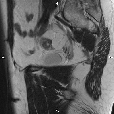 File:Cervical adenocarcinoma (Radiopaedia 65011-73985 Sagittal T2 25).jpg