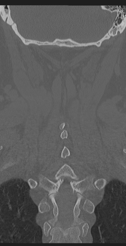 Cervical canal stenosis due to ossification of the posterior longitudinal ligament (Radiopaedia 47260-51823 Coronal bone window 49).png