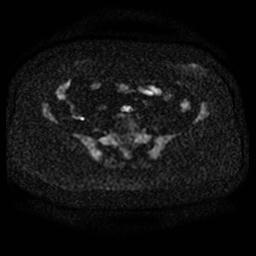 File:Cervical carcinoma (Radiopaedia 67644-77047 Axial DWI 3).jpg