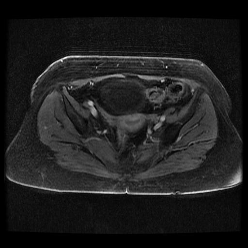 Cervical carcinoma (Radiopaedia 70924-81132 Axial T1 C+ fat sat 148).jpg
