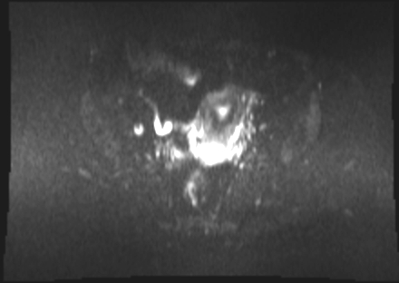 File:Cervical carcinoma (Radiopaedia 88312-104943 Axial DWI 10).jpg