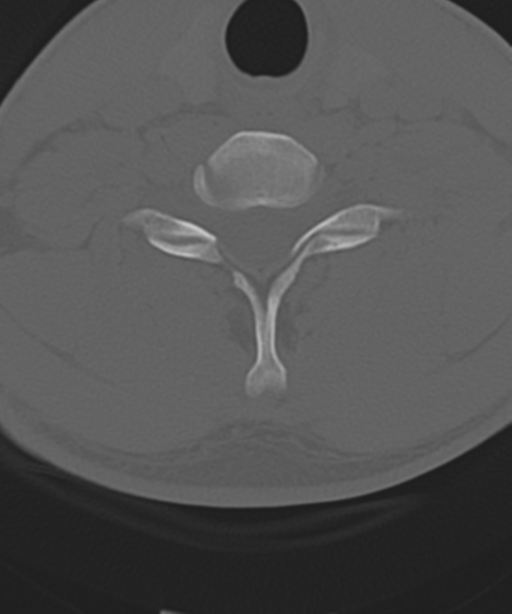 Cervical intercalary bone (Radiopaedia 35211-36748 Axial bone window 47).png