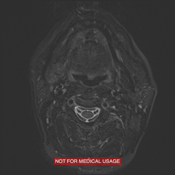 Cervical nerve schwannoma (Radiopaedia 27964-28221 C 25).jpg