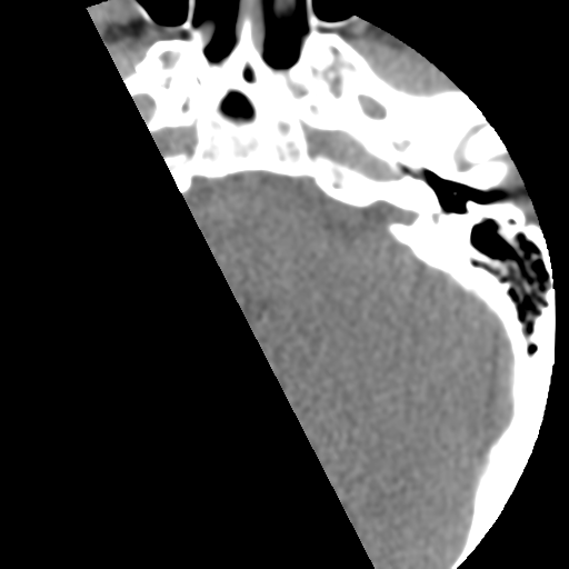 Cervical schwannoma (Radiopaedia 57979-64974 Axial non-contrast 2).png