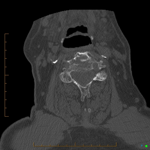 Cervical spine fracture - ankylosing spondylitis (Radiopaedia 76835-88706 Axial bone window 108).jpg
