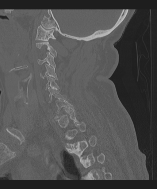 Cervical spine fracture in the setting of ankylosis (Radiopaedia 37038-38715 Sagittal bone window 54).png