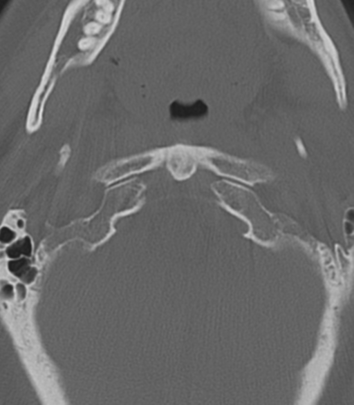 File:Cervical spine fractures with vertebral artery dissection (Radiopaedia 53296-59268 Axial bone window 10).png