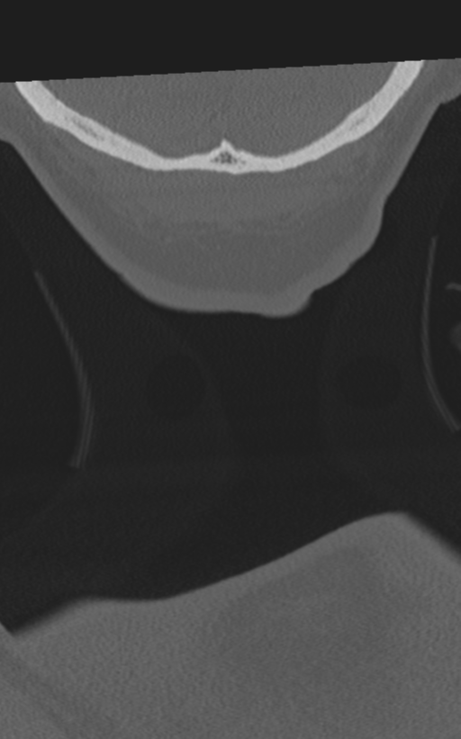 Cervical spine fractures with vertebral artery dissection (Radiopaedia 53296-59268 Coronal bone window 85).png