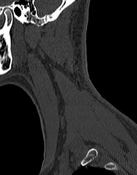 Cervical spondylodiscitis (Radiopaedia 28057-29489 Sagittal bone window 59).jpg