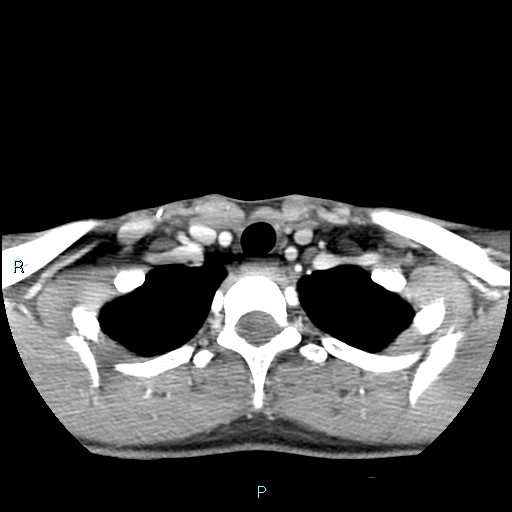Cervical thymic cyst (Radiopaedia 88632-105335 B 30).jpg